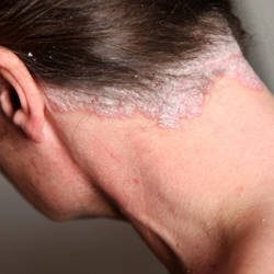 Descubre trucos sobre la psoriasis en el cuero cabelludo