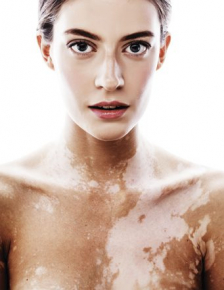 Fototerapia para el tratamiento de la psoriasis y el vitíligo