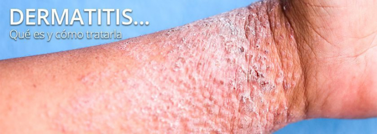 DERMATITIS... ¿qué Es Y Qué Tratamientos Tiene? - Tecnosa