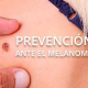 Aumentan los casos de cáncer de piel en España