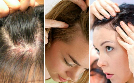 Descubre trucos sobre la psoriasis en el cuero cabelludo