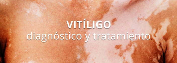 Diagnóstico Y Tratamiento Del Vitíligo En La Clínica - Tecnosa