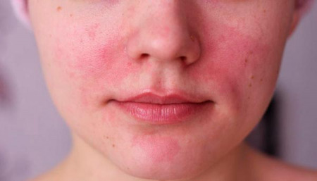 Señalados por tener ‘mala piel’: ¿una nueva forma de clasismo?